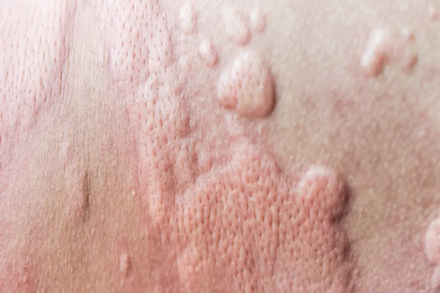 الأرتكاريا حساسية الجلد وأنواعها بالصور
